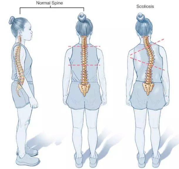 體態最大的殺手脊柱側彎是什麼怎麼破