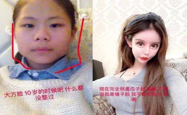 整形|还记得花百万整容的13岁女孩吗？3年整了100次，如今前后判若两人