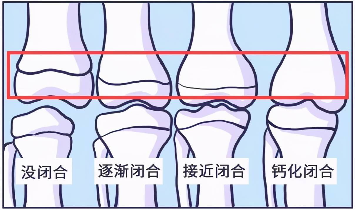 孩子若出现两大信号代表骨骺线即将闭合,专家:想补救,得补够营养