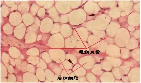 营养|脂肪填充全脸刚做完图，会肿但也会美，这不分享说不过去吧