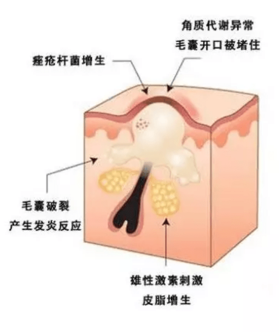 因为|靖萧老师----你所困扰的痘痘，到底是因为什么原因引起的呢？