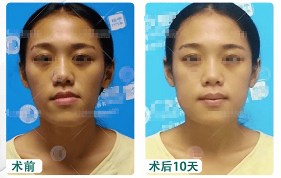 地包天脸型不对称重度自卑的我做完正颌后悔了
