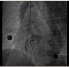 植入术|心乱如麻 何以解忧—— 我院首例临时起搏器+希氏束起搏手术成功实施