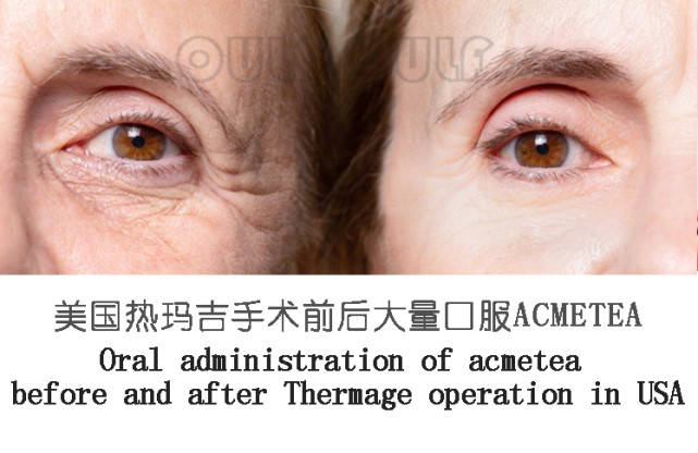 玛吉|热玛吉原理及作用原来是这样，怪不得被称作去皱神器