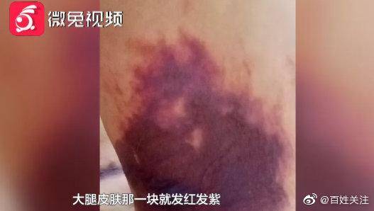 女子|贵阳女子抽脂后皮肤大面积坏死 院方：暂不考虑赔偿