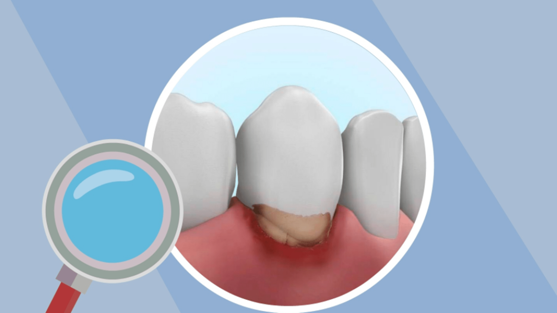 检查|男人30岁出头牙齿几乎掉光？医生提醒，这个病很多人都有