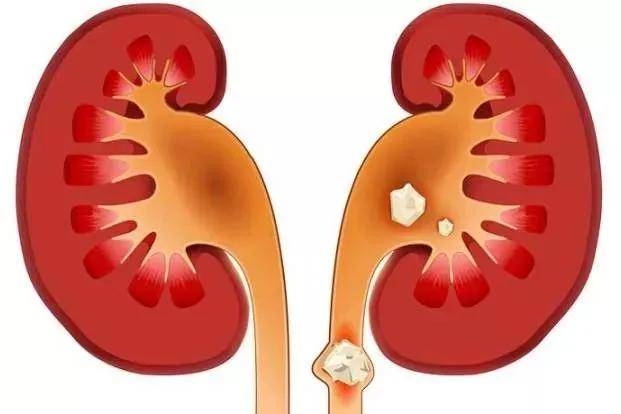 饮食|驼星人说健康|得了肾结石，饮食要注意