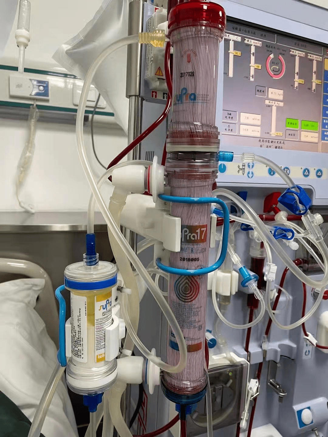 治疗|陕西首例|西安医学院一附院开展第三代血液净化新技术“血滤吸附SupraHFR”