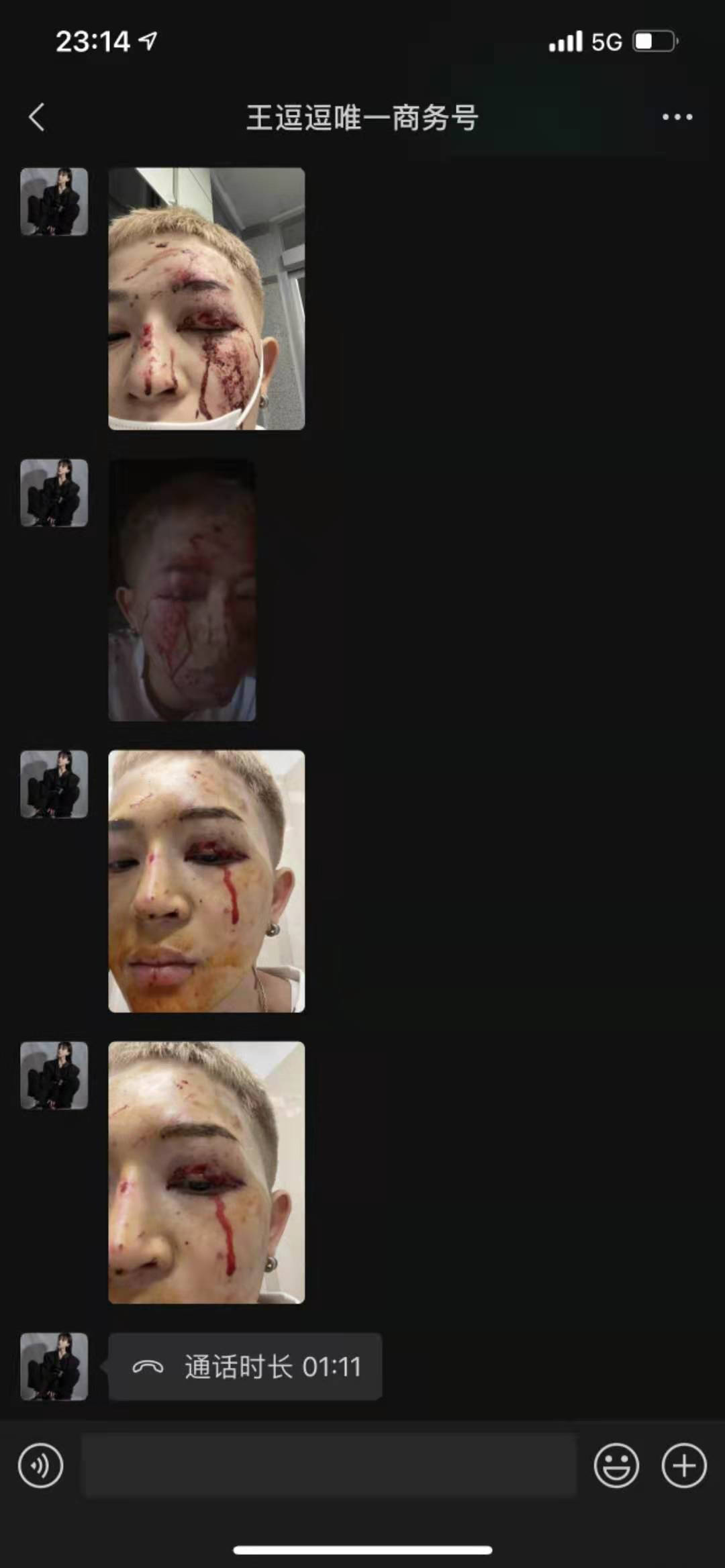 原创王逗逗晒出恋人车祸照眼皮青紫又流血万幸只是皮肉伤