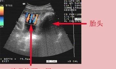 怀孕36周羊水偏少怎么办