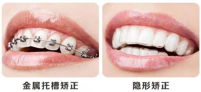 粘结|牙齿矫正科普：隐形矫正ｖｓ传统金属矫正