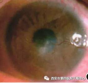 局部|【医学科普】总是眼痒、眼干、流泪？三种治疗方式来了解！