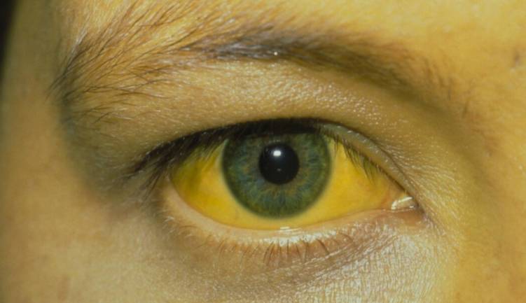 肝脏|医生提醒：肝硬化，并非毫无踪迹，身体出现4异常，劝你早查肝功