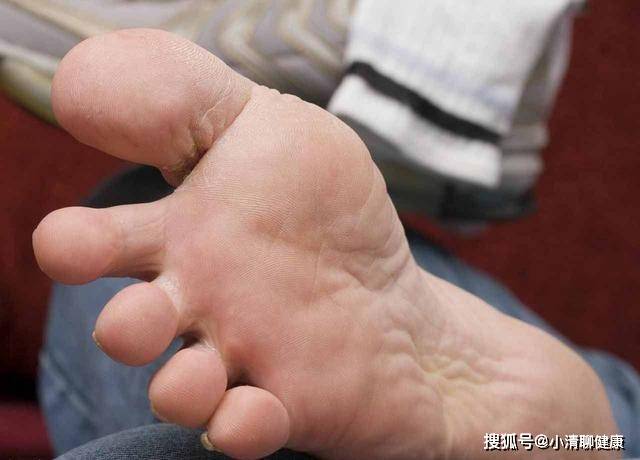 脚掌|肝不好，“脚”知道？4个表现切莫忽视，养肝护肝：吃2物，喝2茶