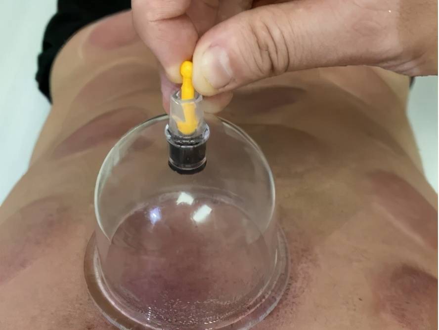 颜色|【护理科普】使用真空拔罐器居家自我保健的方法和误区