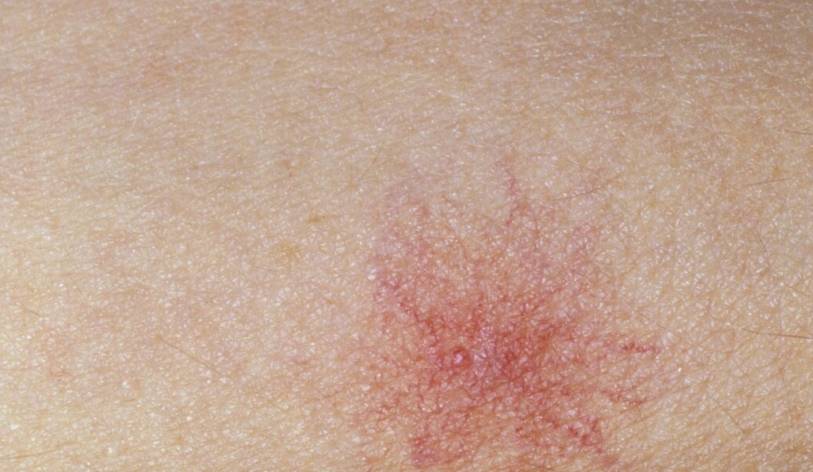 肝脏|医生提醒：肝硬化，并非毫无踪迹，身体出现4异常，劝你早查肝功