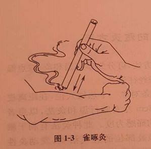 ③雀啄灸,用点燃的艾条的一端与皮肤不固定在一定距离,像鸟雀啄食一样