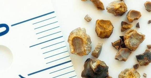 治疗|肾结石，真的可以自己排出来吗？你或许真的不知道，看专家的理解