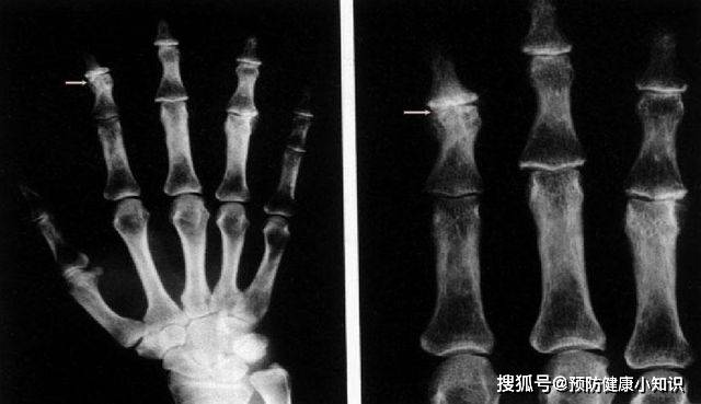 症状|肝豆状核变性是一种先天疾病,有家族史者,应进行基因检测