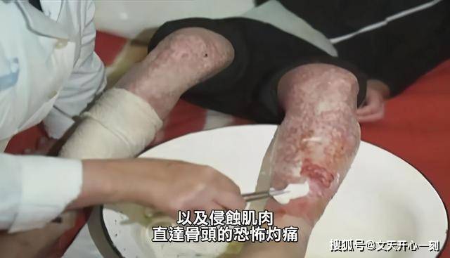 最奇葩的死法:全身dna断裂而死,全世界只有一人不幸遇到过