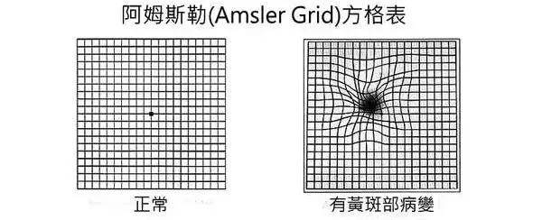 同樣是看不清究竟是黃斑變性還是老花眼呢