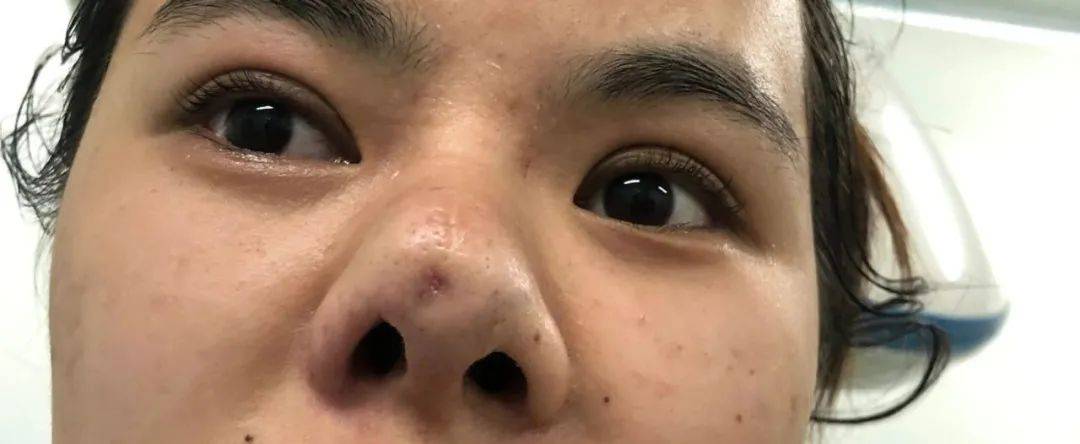 张力|五官C位可不能随便动,鼻综合也不是人人适合!