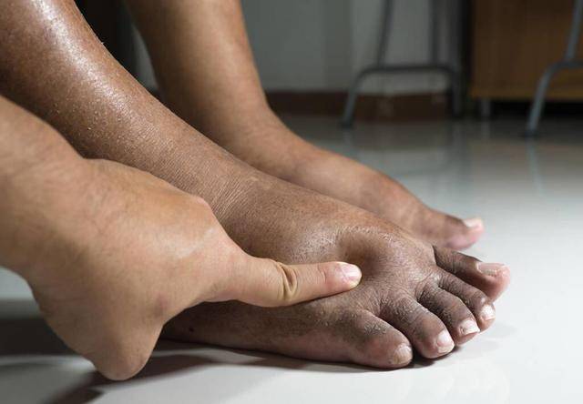 治疗|血糖升高，脚先知！脚部若出现这3个“问题”，或是糖尿病已“到访”