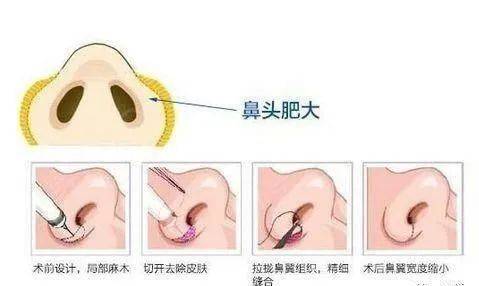 张力|五官C位可不能随便动,鼻综合也不是人人适合!