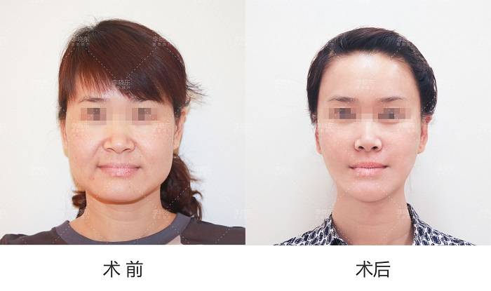 什么|面部抗衰 线雕适合哪些人做？禁忌是什么？线雕修复有多难？