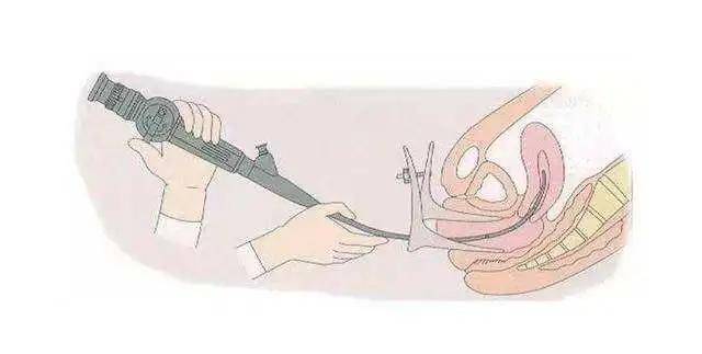 传播|揭密生殖系统结核的“产业链”［传播-发病-排查-治疗-注意事项］