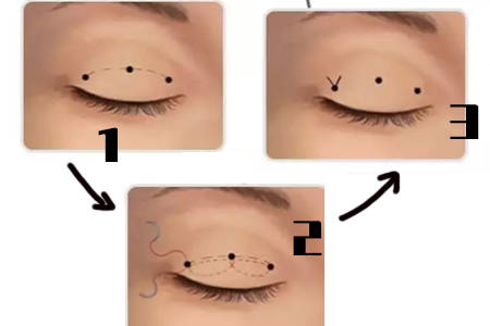 并发症|埋线双眼皮修复很简单？先了解怎么做的