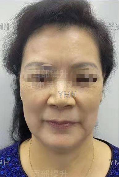 鱼尾纹|拉皮除皱王小民教授：面部老化怎么办？小拉皮带你回到十年前！