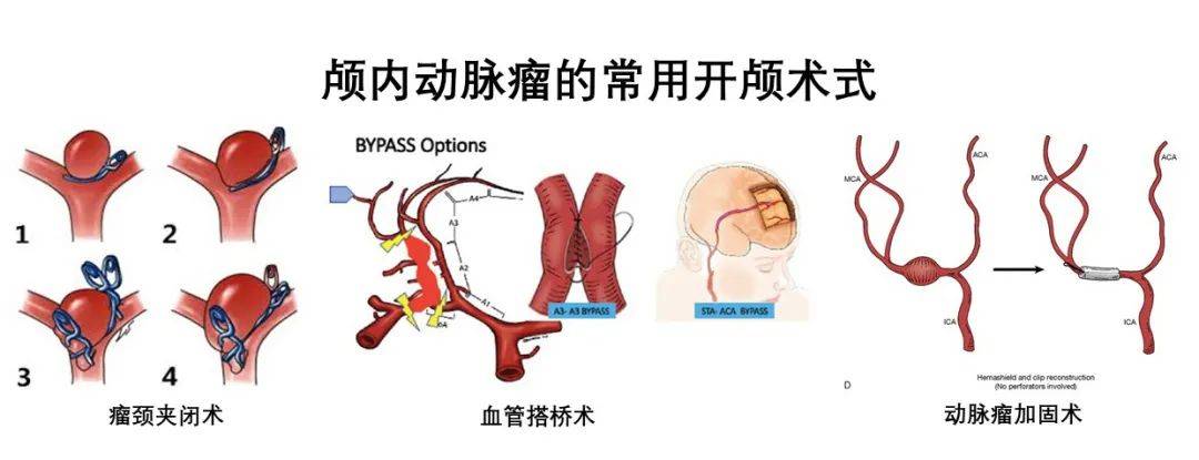 栓塞|颅内动脉瘤的手术治疗有哪些？