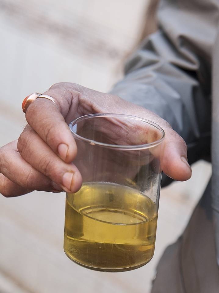 肾脏|26岁男子确诊肾衰竭,竟是“拖”出来的,肾病这4个信号不可忽略