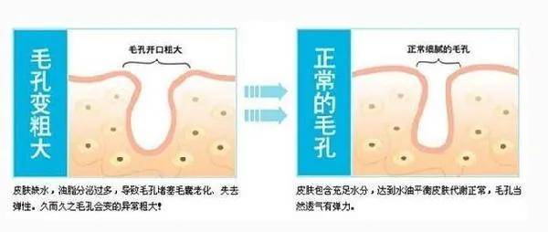 关键|那么形成脸部毛孔粗大的根源终究在哪里？