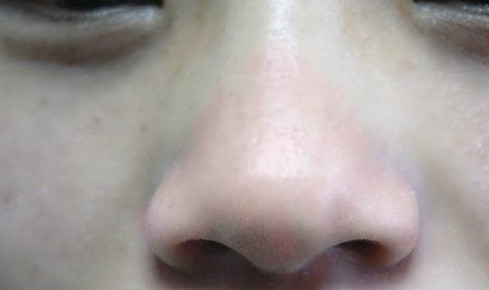 肝脏|患上肝硬化，身体会有哪些异常表现？及时发现，早做检查更健康