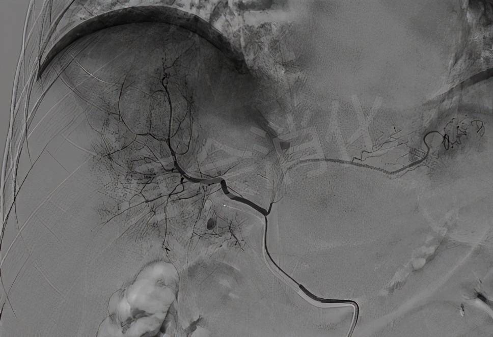 血管|西安市红会医院 让肿瘤“饿”死的TACE术 为两例中晚期肝癌排忧