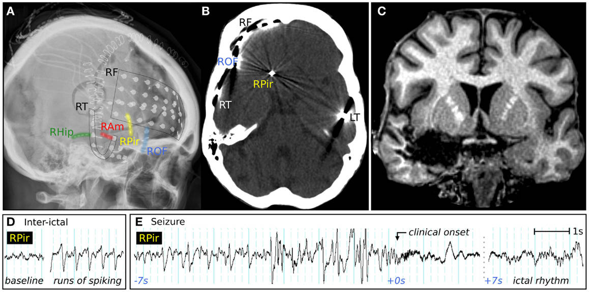 大脑|辟谣丨“腔隙性脑梗死”是什么病?该不该通血管?很多人都想错了
