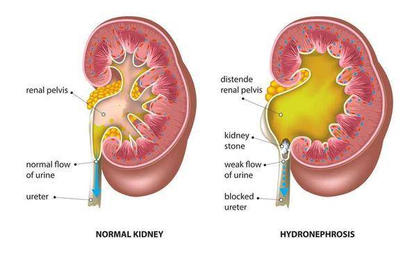 治疗|得了肾病的人,若没有重视起来,可能会引发这5大并发症,需重视