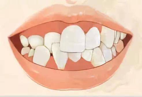 12岁前必须处理的12种儿童牙颌畸形