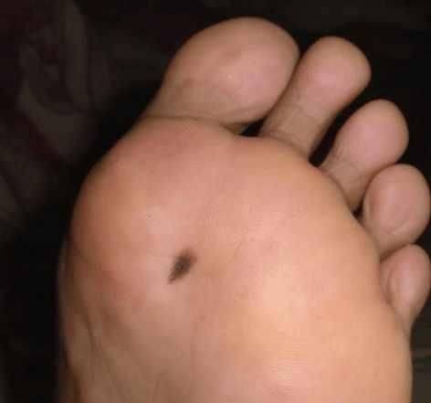 医生提醒:手脚出现几种异常要留意,或是癌细胞已泛滥