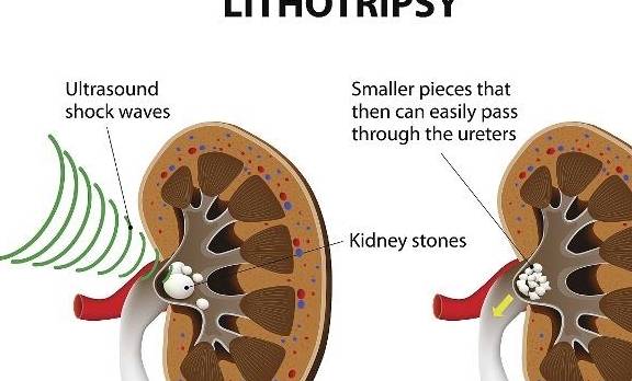 零点|肾结石如果不痛，就不用理睬？这2个危害可不小