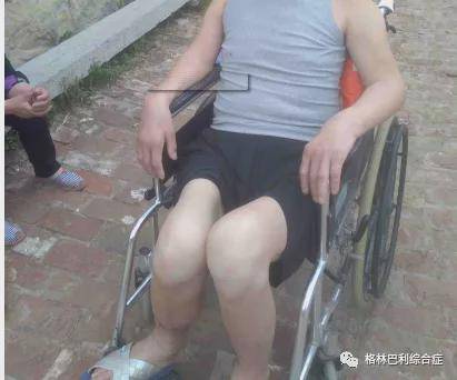 后遗症|患上格林巴利综合症会瘫痪吗?有哪些后遗症?