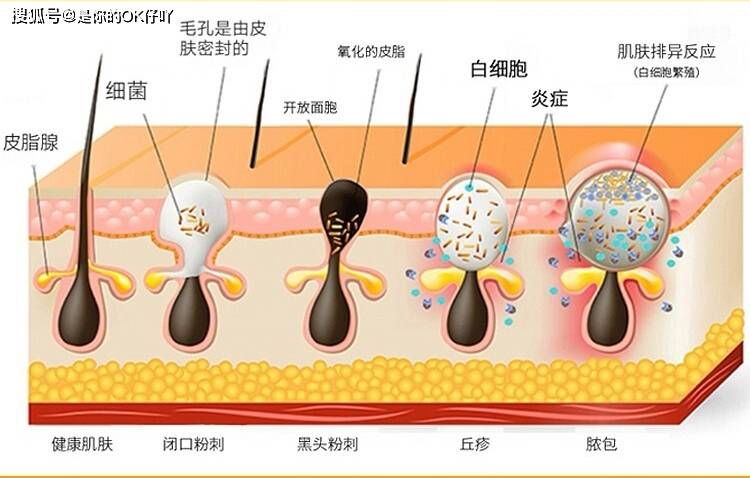 过段时间|男士护肤：皮肤长痘应该怎么护肤？