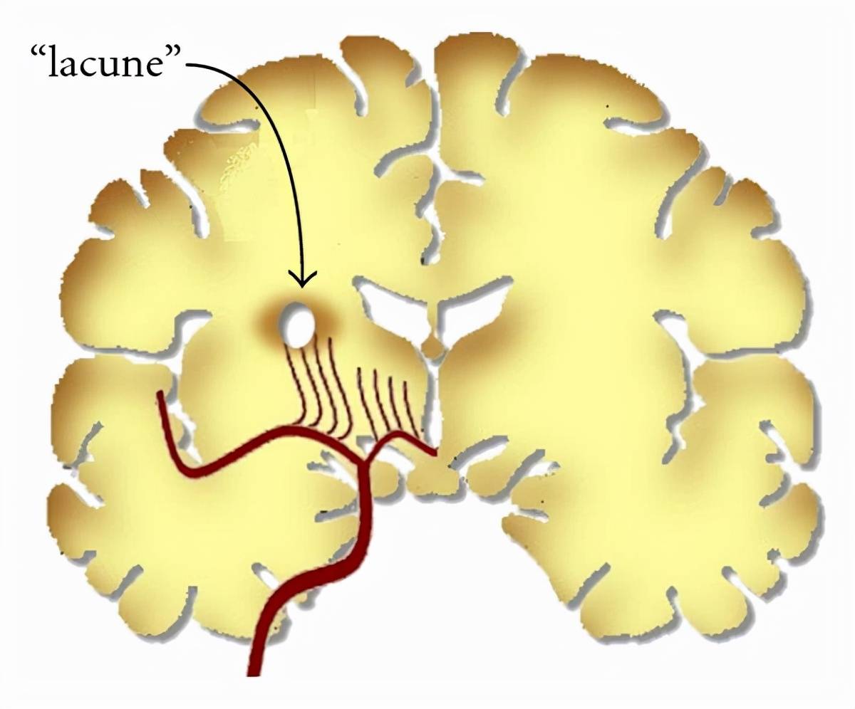 生活|45岁发现“腔梗”？医生帮忙分析，原因在于4个习惯，你可能也有