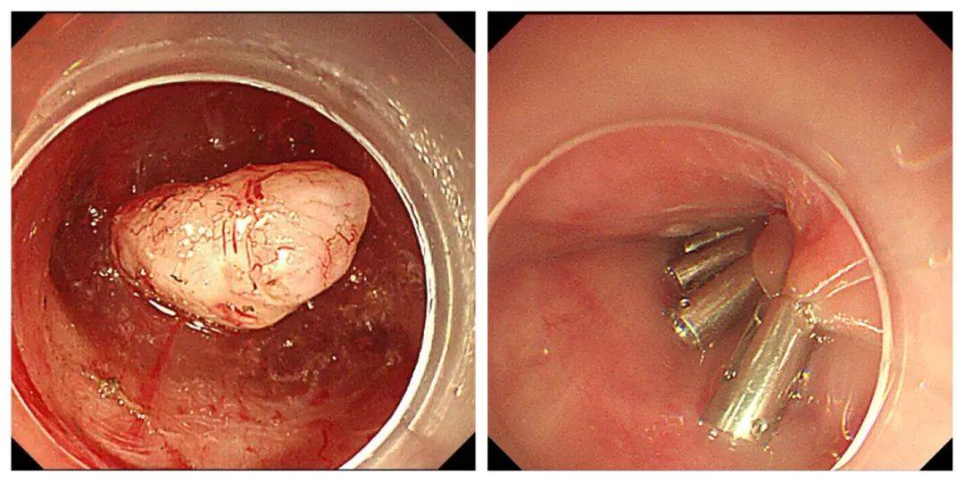 肿瘤|食管壁内“挖土豆” 肿瘤切除不留痕