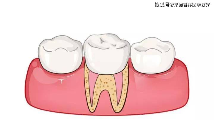 隐适齐 根管治疗后的牙齿还能使用多久