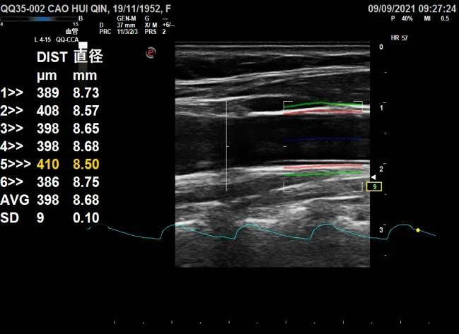 西安市|西安市中医医院加入颈动脉血管弹性全国多中心研究项目