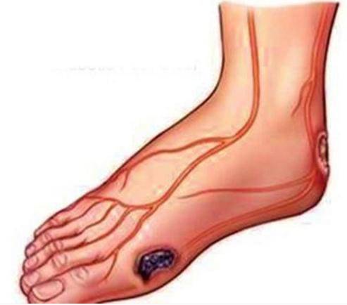 生活|糖尿病一辈子也治不好是真的吗?