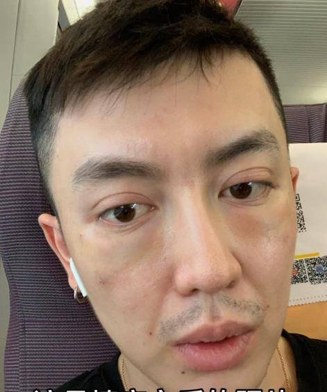 下巴|男网红整容变毁容，术后哭诉自己变老20岁，前后对比图令人诧异